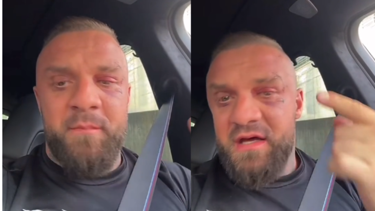 Me plagë dhe sy të nxirë/ Medi Iseni publikon për herë të parë pas sherrit me Noizy-n: Faleminderit policisë së Kosovës