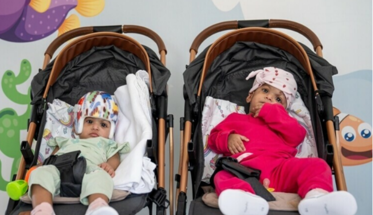 Lindën me kokë të bashkuar, ekipi me 50 mjekë kryejnë operacionin e vështirë për binjaket 11 muajshe